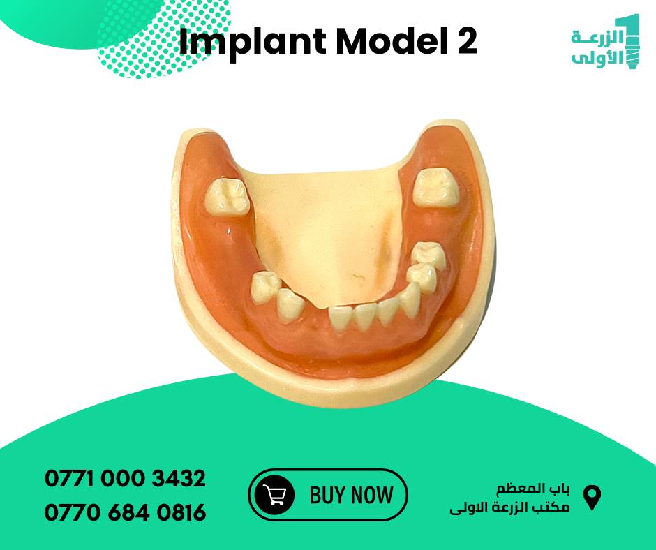 Implant Model 2