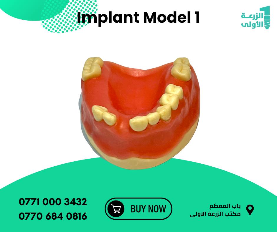 Implant Model 1