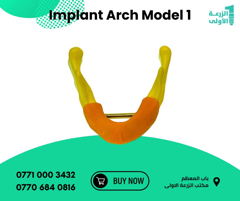 Implant arch 1