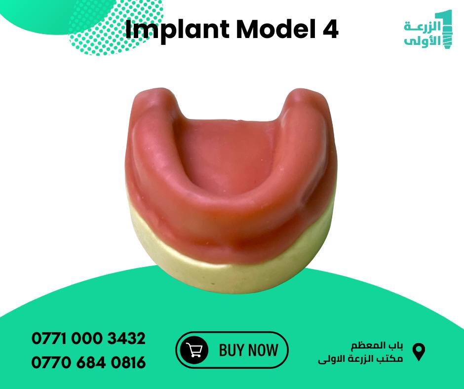 Implant Model 4