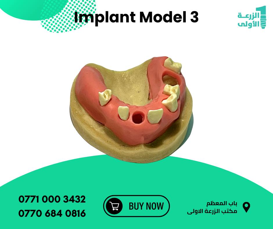 Implant Model 3