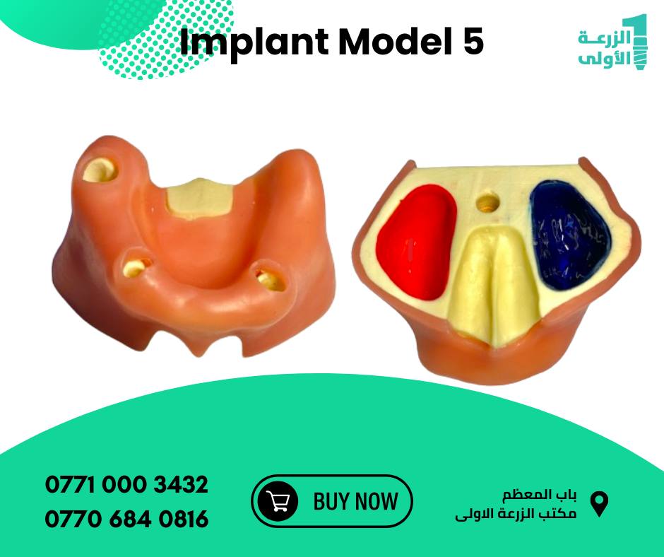 Implant Model 5